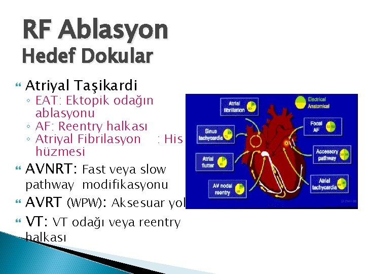 RF Ablasyon Hedef Dokular Atriyal Taşikardi ◦ EAT: Ektopik odağın ablasyonu ◦ AF: Reentry