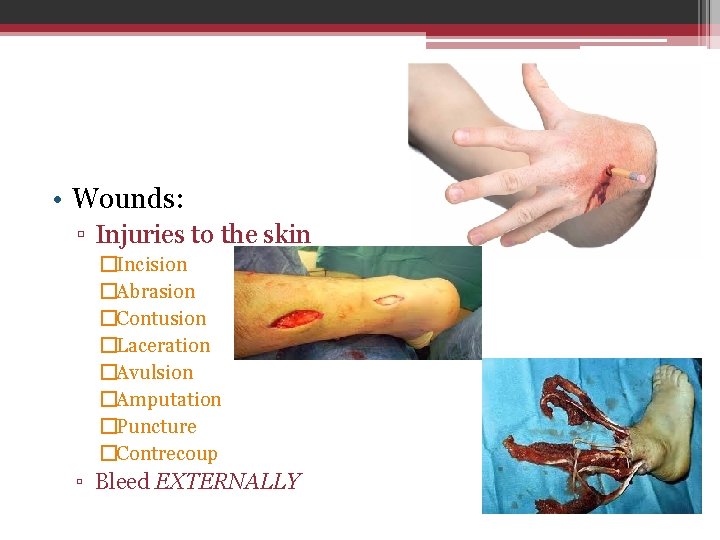  • Wounds: ▫ Injuries to the skin �Incision �Abrasion �Contusion �Laceration �Avulsion �Amputation