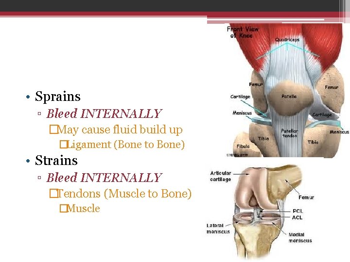  • Sprains ▫ Bleed INTERNALLY �May cause fluid build up �Ligament (Bone to