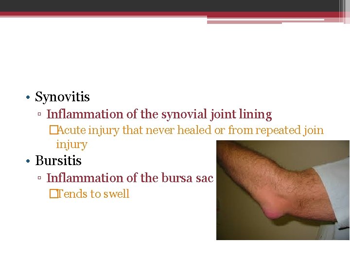  • Synovitis ▫ Inflammation of the synovial joint lining �Acute injury that never