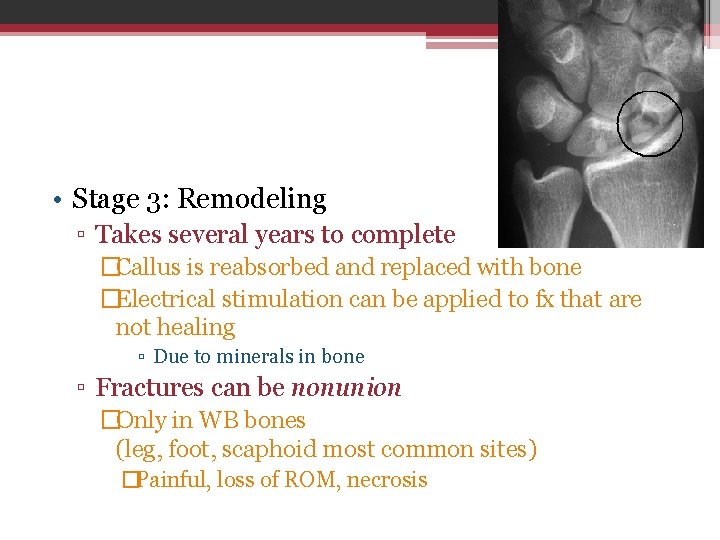  • Stage 3: Remodeling ▫ Takes several years to complete �Callus is reabsorbed