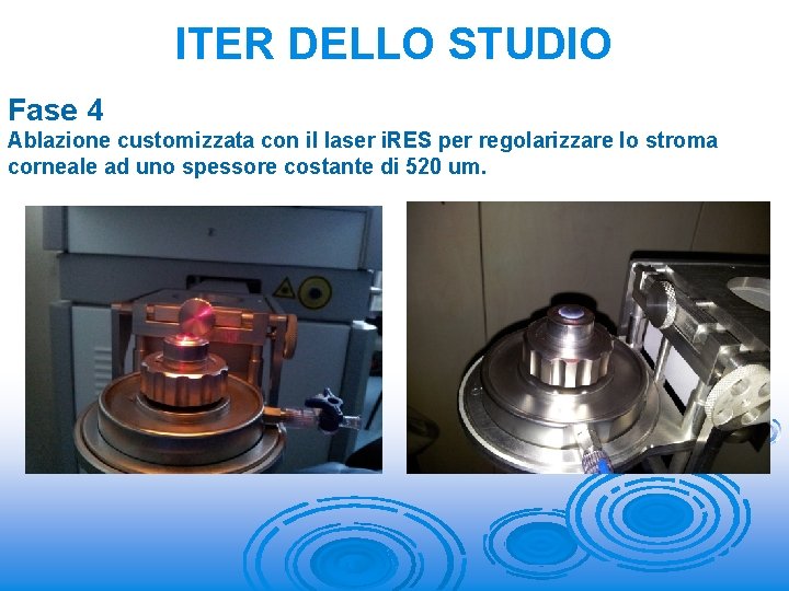 ITER DELLO STUDIO Fase 4 Ablazione customizzata con il laser i. RES per regolarizzare