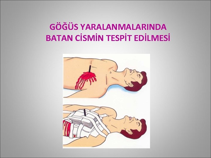 GÖĞÜS YARALANMALARINDA BATAN CİSMİN TESPİT EDİLMESİ 