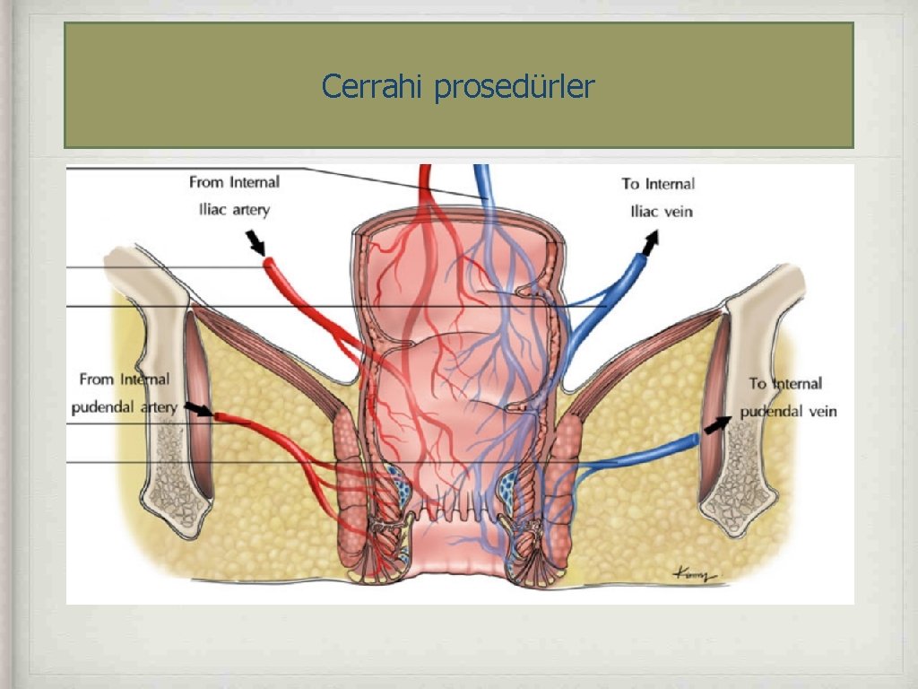 Cerrahi prosedürler Eksizyon Açık Kapalı (Milligan Morgan 1939 / Ferguson 1954) Hemoroidal arter ligasyonu