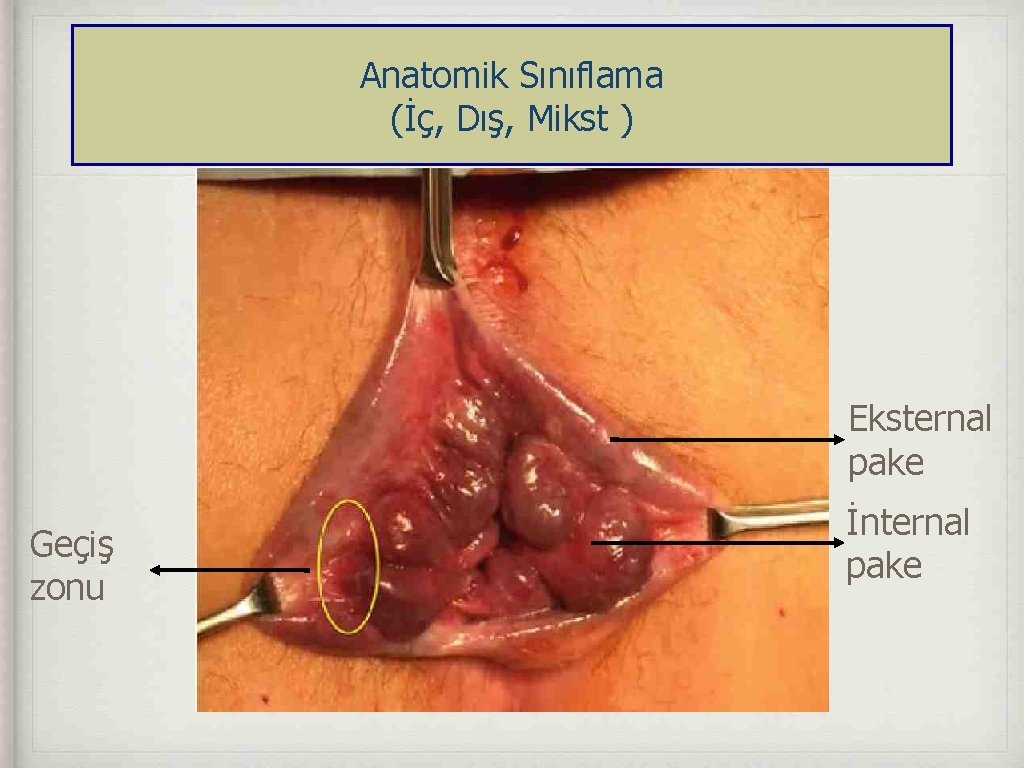 Anatomik Sınıflama (İç, Dış, Mikst ) Eksternal pake Geçiş zonu İnternal pake 