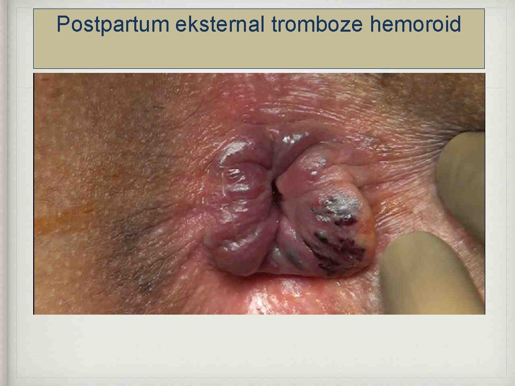 Postpartum eksternal tromboze hemoroid 