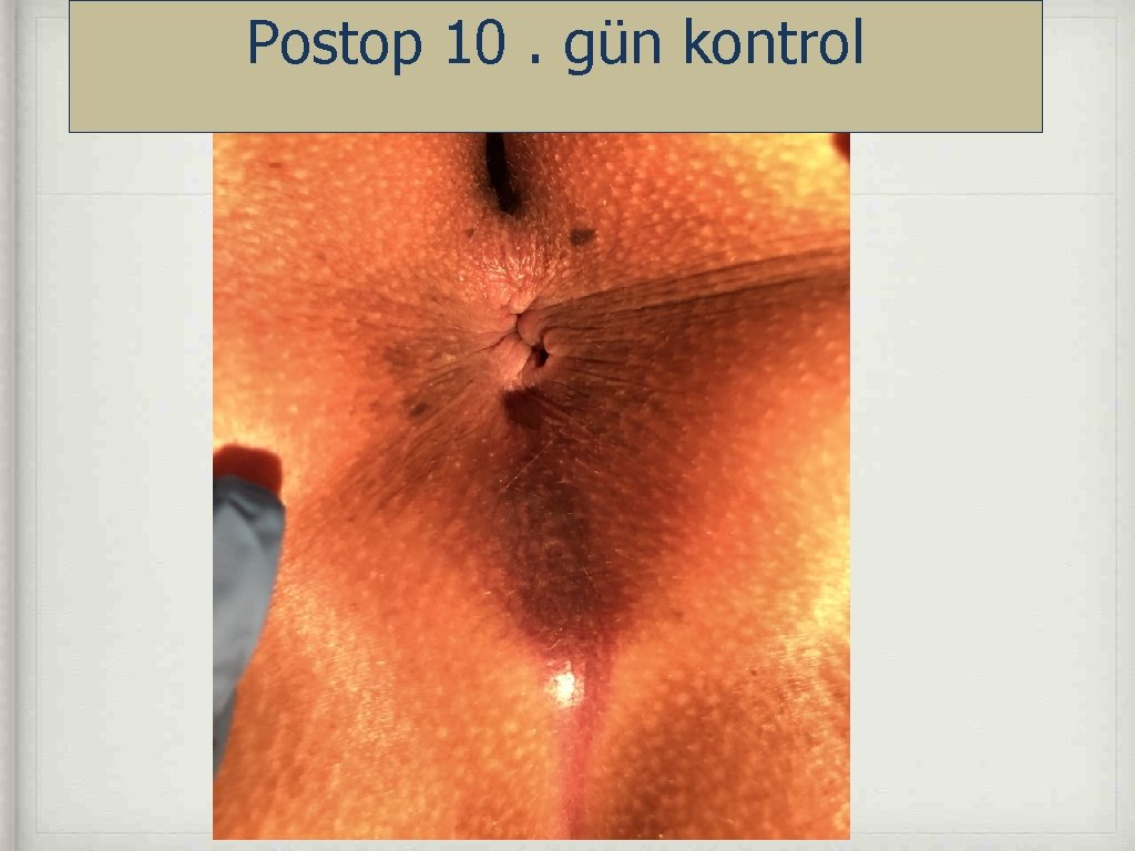 Postop 10. gün kontrol 