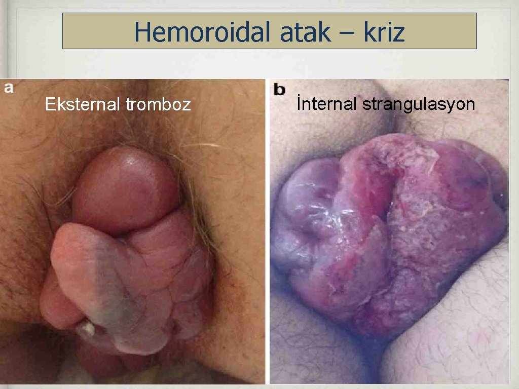 Hemoroidal atak – kriz Eksternal tromboz İnternal strangulasyon 