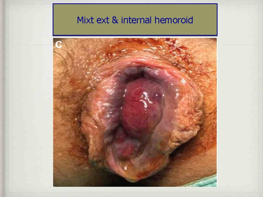 Mixt ext & internal hemoroid 