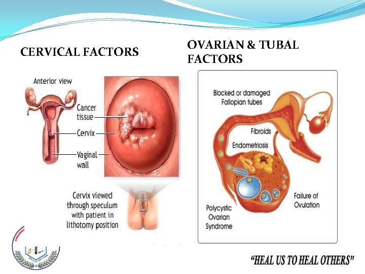 CERVICAL FACTORS OVARIAN & TUBAL FACTORS 