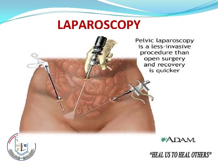 LAPAROSCOPY 