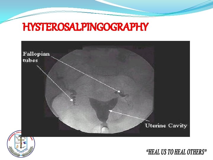 HYSTEROSALPINGOGRAPHY 