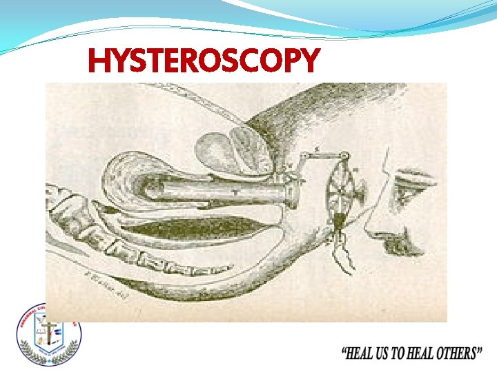 HYSTEROSCOPY 