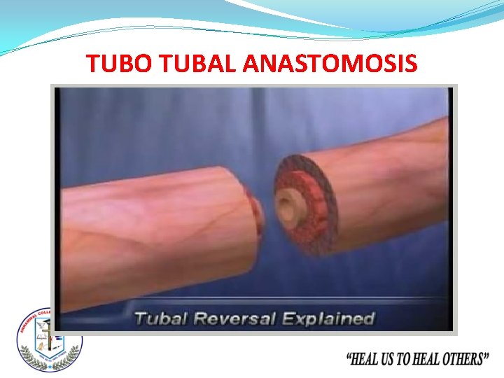 TUBO TUBAL ANASTOMOSIS 