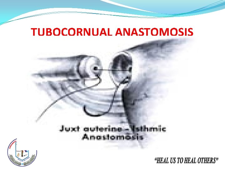 TUBOCORNUAL ANASTOMOSIS 