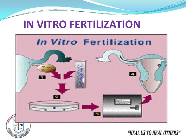 IN VITRO FERTILIZATION 