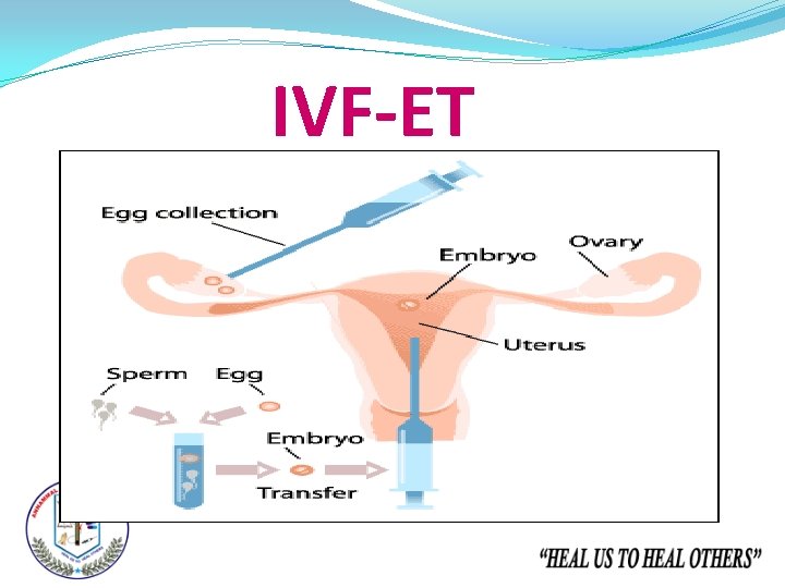 IVF-ET 