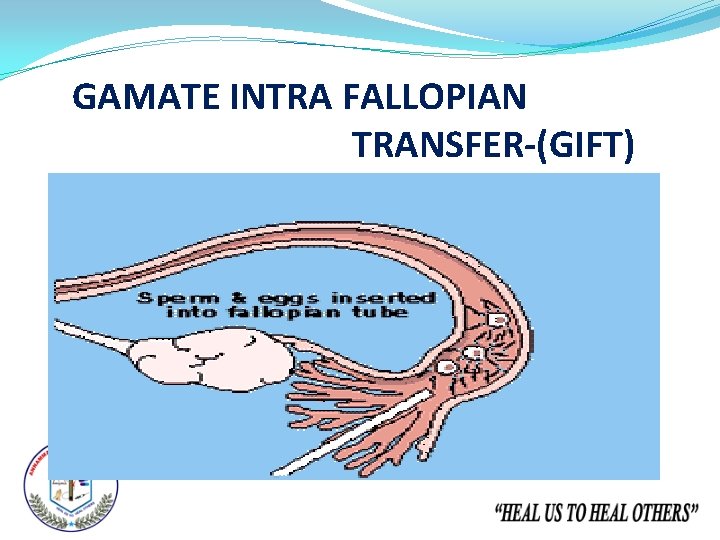 GAMATE INTRA FALLOPIAN TRANSFER-(GIFT) 