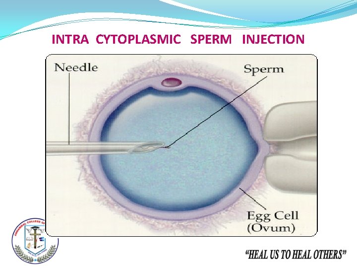 INTRA CYTOPLASMIC SPERM INJECTION 