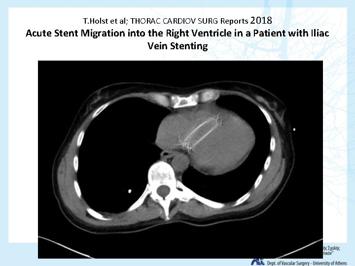 T. Holst et al; THORAC CARDIOV SURG Reports 2018 Acute Stent Migration into the