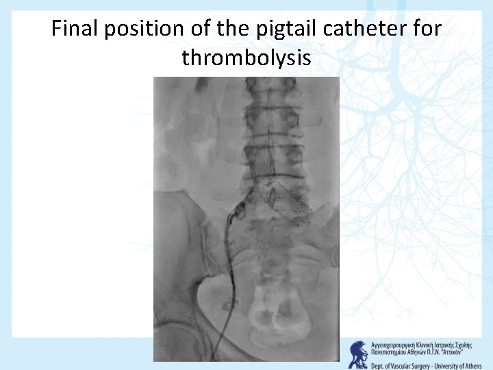 Final position of the pigtail catheter for thrombolysis 