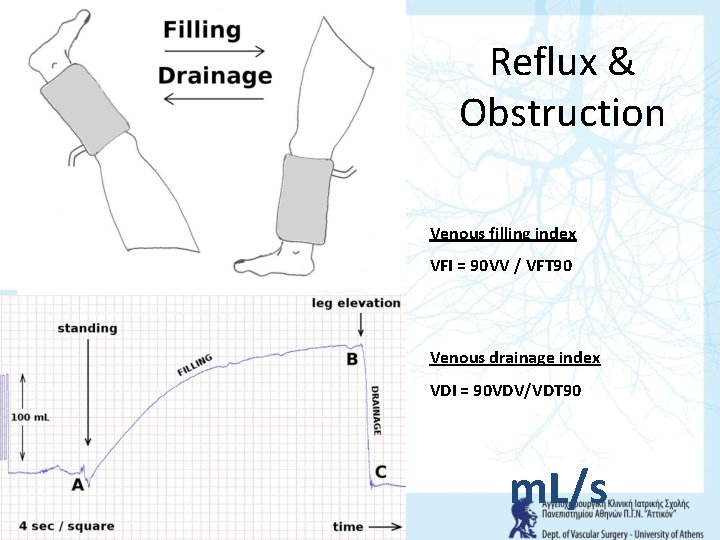 Reflux & Obstruction Venous filling index VFI = 90 VV / VFT 90 Venous