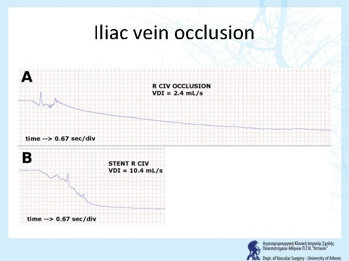 Iliac vein occlusion 