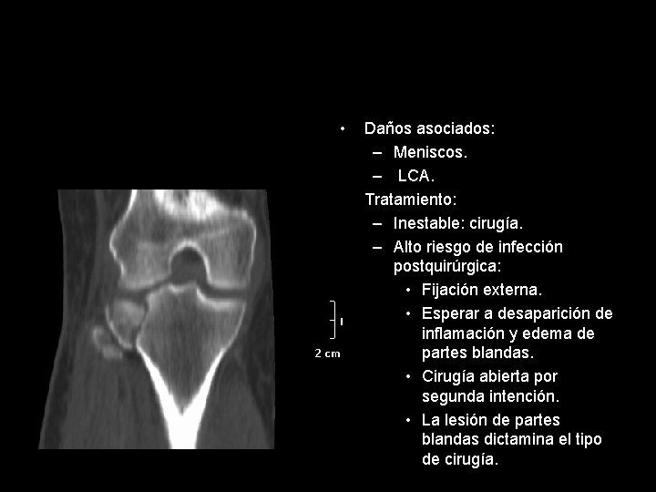  • • Daños asociados: – Meniscos. – LCA. Tratamiento: – Inestable: cirugía. –