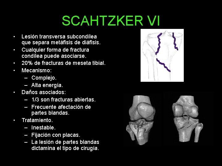 SCAHTZKER VI • • • Lesión transversa subcondílea que separa metáfisis de diáfisis. Cualquier