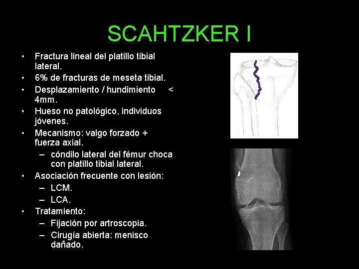 SCAHTZKER I • • Fractura lineal del platillo tibial lateral. 6% de fracturas de