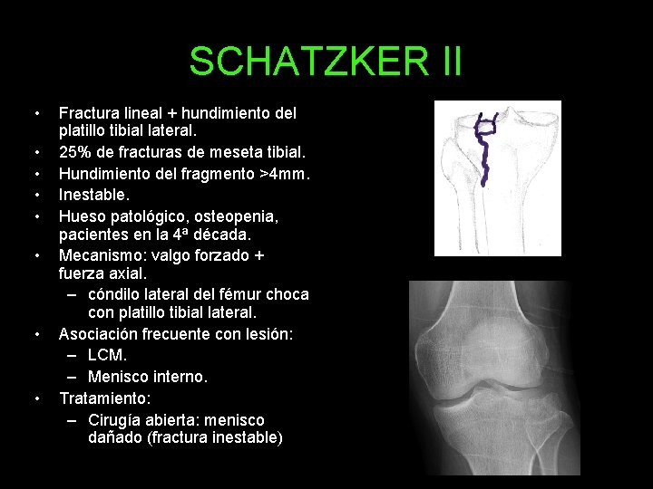 SCHATZKER II • • Fractura lineal + hundimiento del platillo tibial lateral. 25% de