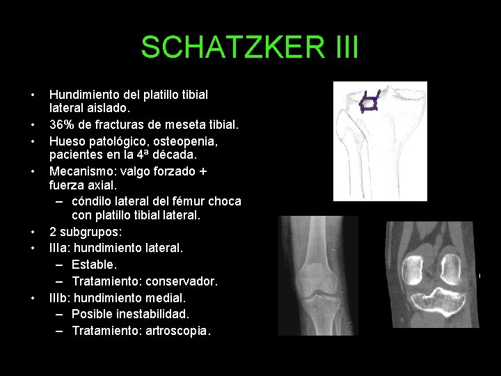 SCHATZKER III • • Hundimiento del platillo tibial lateral aislado. 36% de fracturas de