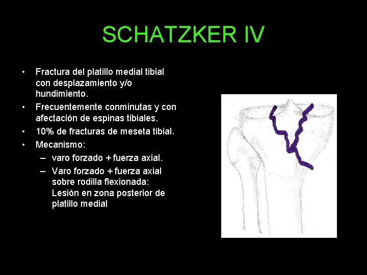 SCHATZKER IV • • Fractura del platillo medial tibial con desplazamiento y/o hundimiento. Frecuentemente