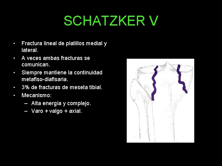 SCHATZKER V • • • Fractura lineal de platillos medial y lateral. A veces