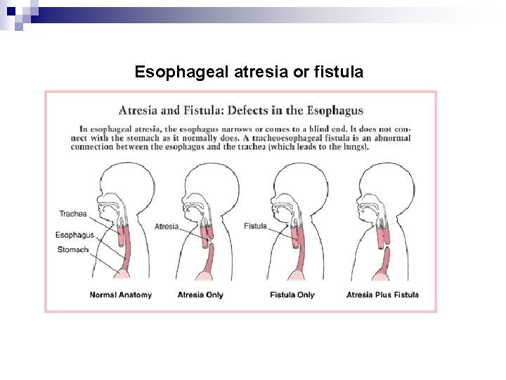 Esophageal atresia or fistula 