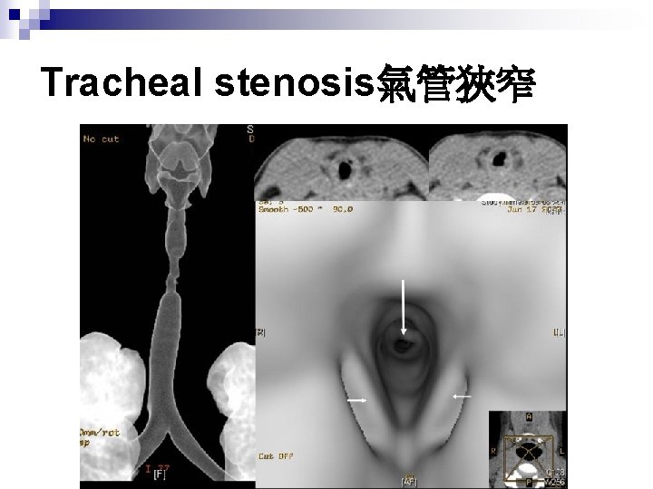 Tracheal stenosis氣管狹窄 