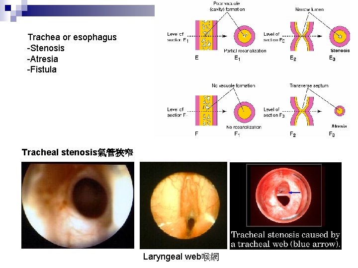 Trachea or esophagus -Stenosis -Atresia -Fistula Tracheal stenosis氣管狹窄 Laryngeal web喉網 