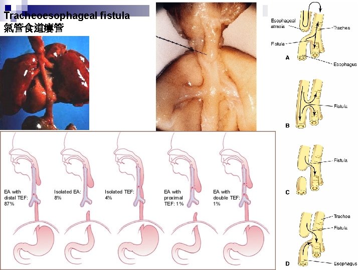 Tracheoesophageal fistula 氣管食道瘻管 