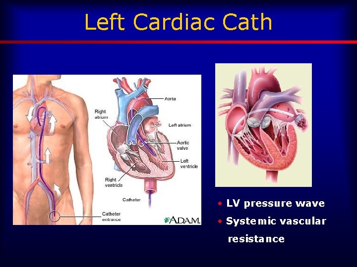 Left Cardiac Cath • LV pressure wave • Systemic vascular resistance 