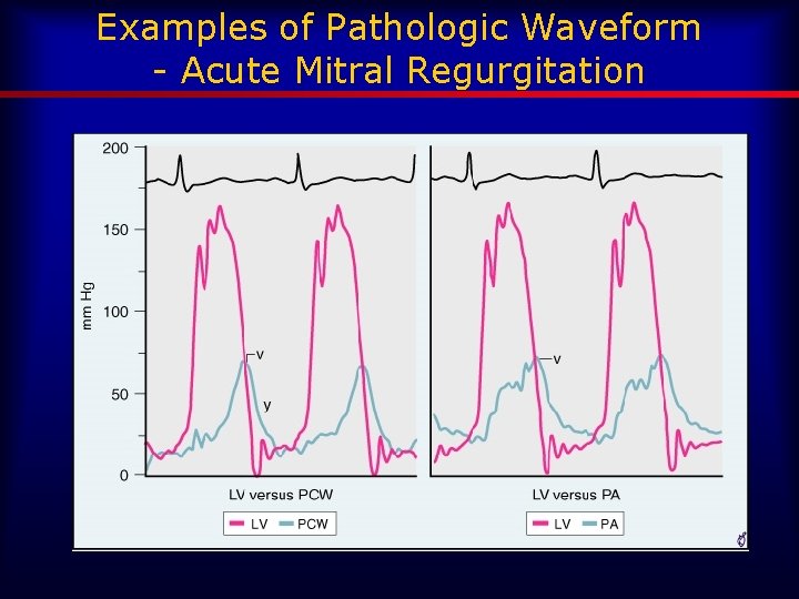 Examples of Pathologic Waveform - Acute Mitral Regurgitation 