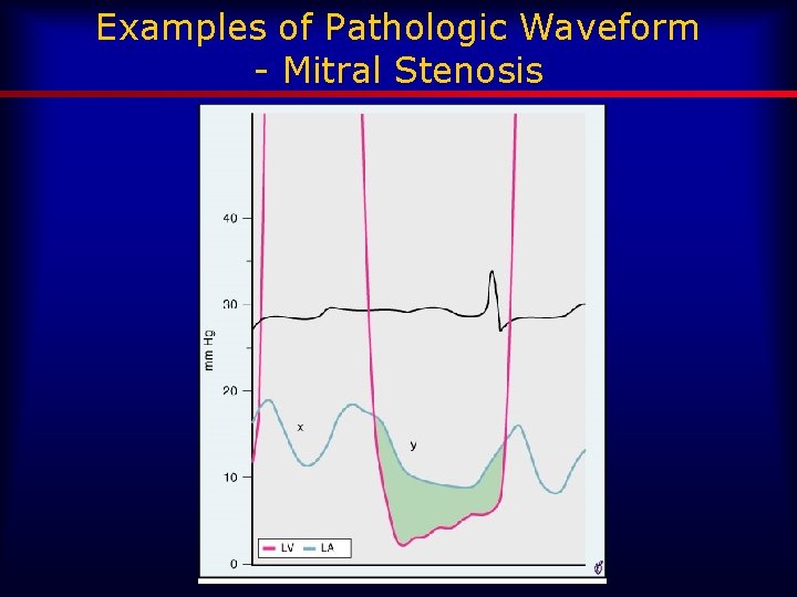 Examples of Pathologic Waveform - Mitral Stenosis 