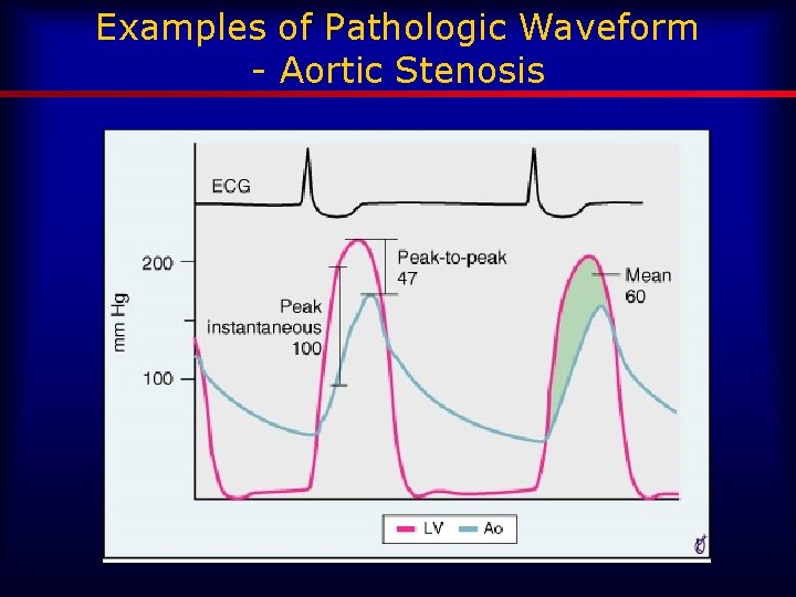 Examples of Pathologic Waveform - Aortic Stenosis 