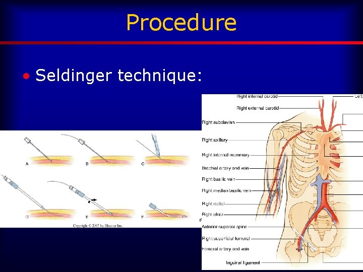 Procedure • Seldinger technique: 