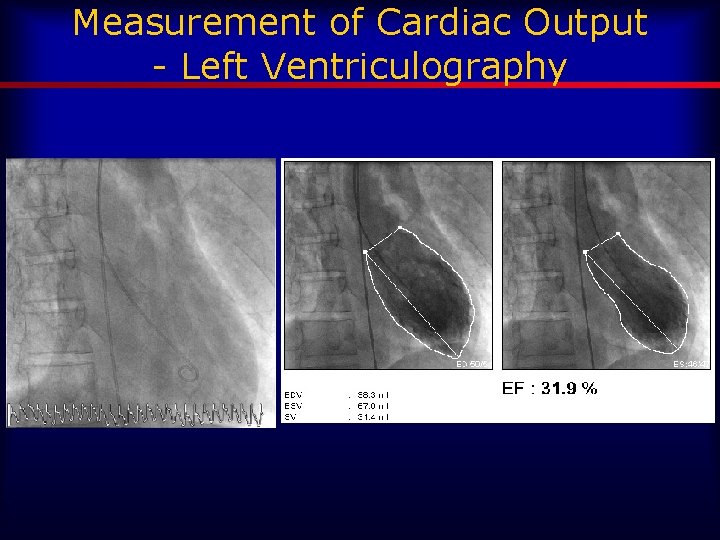 Measurement of Cardiac Output - Left Ventriculography 