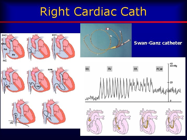 Right Cardiac Cath Swan-Ganz catheter 