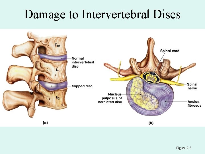 Damage to Intervertebral Discs Figure 9– 8 