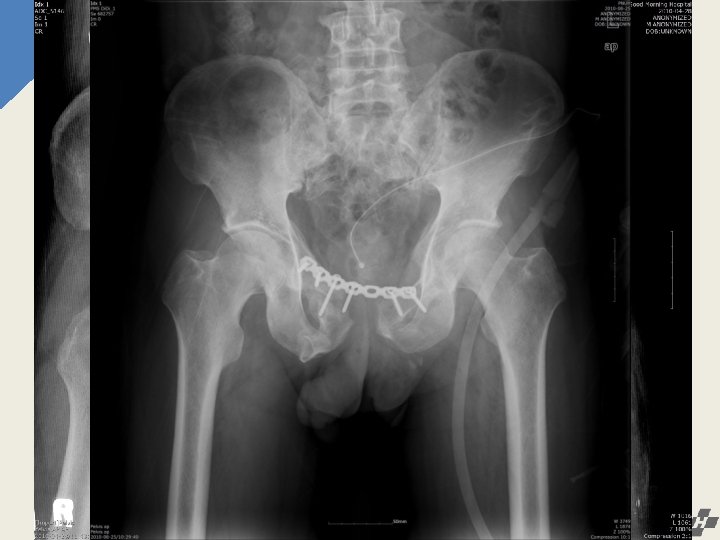 External fixation 