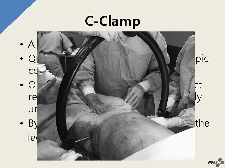 C-Clamp • A form of external fixation. • Quickly placement without fluoroscopic control •