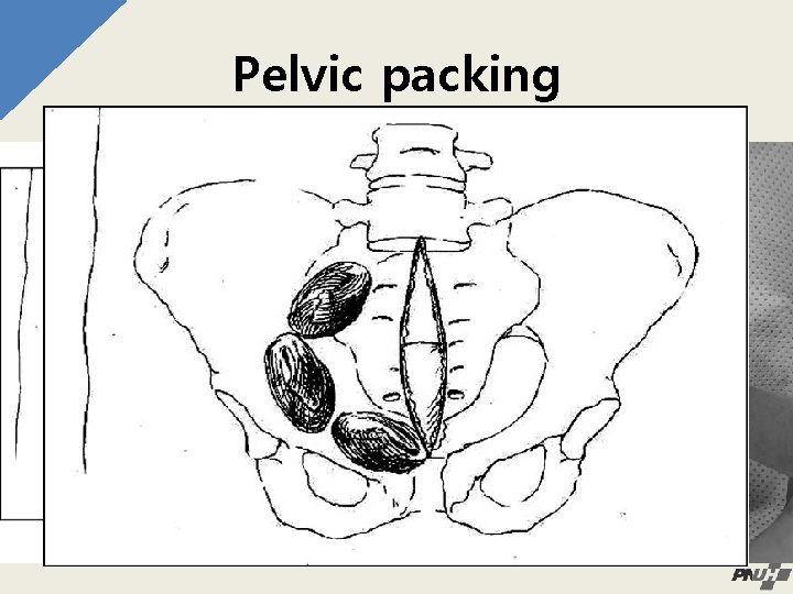 Pelvic packing • Direct surgical management • Direct retroperitoneal packing via transabdominal approach •