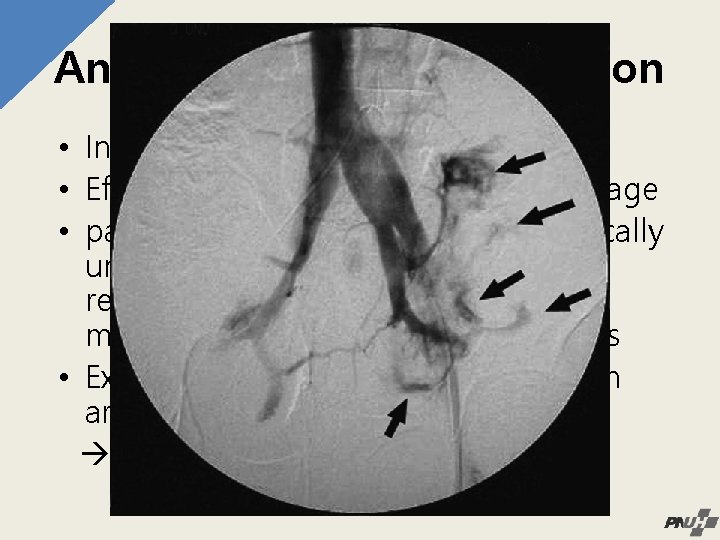 Angiography & Embolization • Initially described as early as 1972 • Effective means on